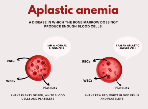 Aplastic-Anemia-Treatment