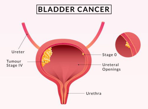 Bladder-cancer
