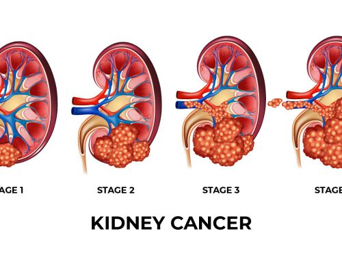 Kidney-Cancer-100
