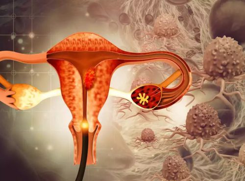 Ovarian Cancer Talcum Lawsuit